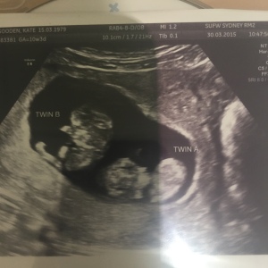 twin pregnancy, ultrasound, twin ultrasound, identical twins